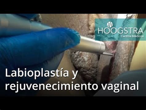 labios vaginales grandes|Hipertrofia Vaginal Qué es y cómo se trata